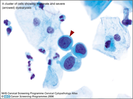 Abnormal Cervical Smear