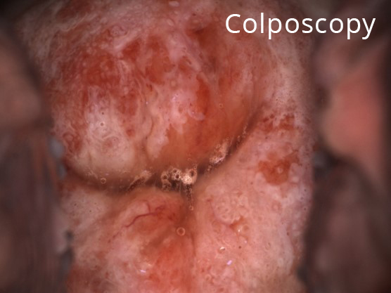 Colposcopy