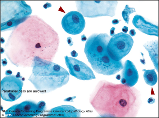 Normal Cervical Smear